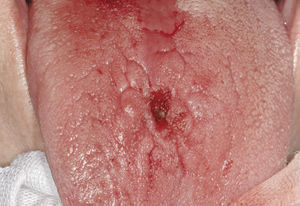 Escisión completa con láser de CO2 del papiloma de células escamosas.