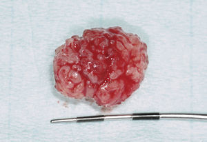 Remisión de la pieza extirpada para el exa-men histopatológico.