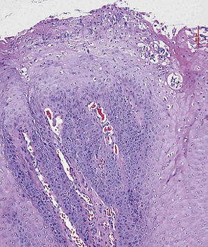 La imagen histológica muestra una proliferación epitelial marcada con crestas epidérmicas ensanchadas y papilomatosis que penetran profun-damente en el tejido conectivo. En la superficie se observan una tendencia evidente a la queratinización y una coilocitosis (tinción de HE, 10 aumentos).