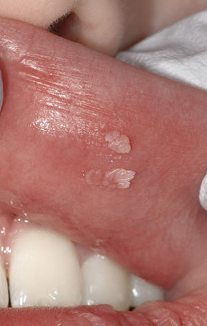 Verru-gas vulgares en una paciente de 15 años de edad. Las dos lesiones se localizan en el labio superior, en la parte izquier-da. La superficie de ambas verrugas muestra un aspecto papilar y verrugoso. De la base de las lesiones parten pro-longaciones del mismo color de la mucosa.