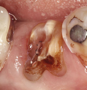 Paciente de 65 años antes de la extracción atraumática del diente 46.