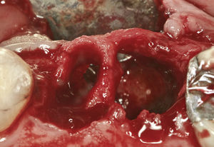 Situación en paciente de 52 años después de la extracción atraumática de los dientes 25 y 26 irrecu-perables con conservación de la tabla ósea vestibular.