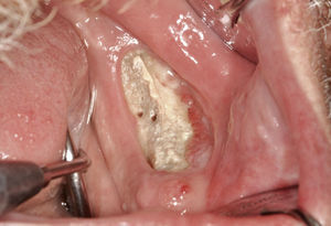 Osteonecrosis asociada a bifosfonatos en un paciente de 62 años con un carcinoma de células rena-les metastásico y tratamiento con bifosfonatos intrave-nosos a dosis altas (Zometa®). Zona extensa de hueso expuesto durante más de 8 semanas en la mandíbula iz-quierda edéntula.