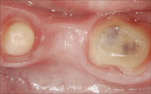 Imagen oclusal de los dientes pilares prepara-dos para la PDF de reemplazo. La zona del póntico se ha modificado para recibir un póntico ovado.