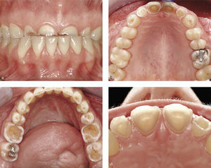 Situación inicial en una paciente de 29 años. La paciente presentó un cuadro de bulimia nerviosa desde los 12 hasta los 27 años de edad. Se considera curada desde hace 2 años. Se observan signos de pérdida de tejido duro dentario de diversa gravedad en todos los dientes (de: Spreafico17).