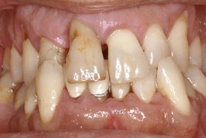 iente 42: traumatismo oclusal y traumatismo provocado por la preparación.