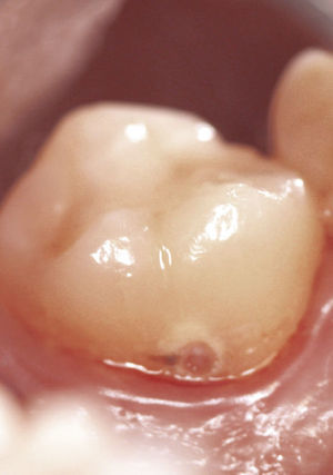 Reabsorción cervical en el diente 17.