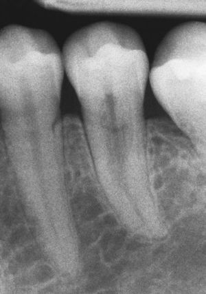 Diente 35: reabsorción cervical que afecta a dos terceras partes de la longitud de la raíz.