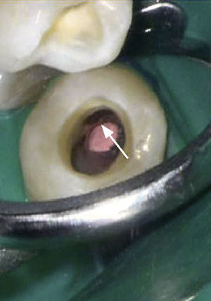 Diente 35: estado después del tratamiento endodóntico en la zona. apical de la reabsorción, puerta de entrada mesiolingual visible.