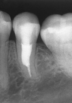 Diente 35: visita de control al cabo de 2 años.