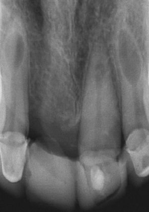 eabsorción interna en los dientes 12, 21 y 22 en la edad adulta después de un traumatismo sufrido 20 años antes en los dientes anteriores.