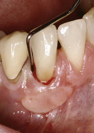 Diente 43: profundidades de sondaje elevadas en la zona de la reabsorción externa.
