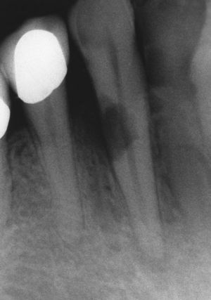 Reabsorción externa en la cara proximal distal del diente 43.