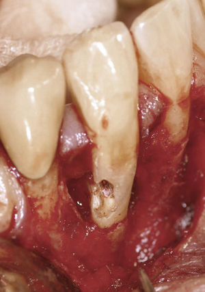 Diente 43: laguna de reabsorción en una imagen intraoperatoria.