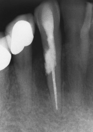 Diente 43: radiografía de control.