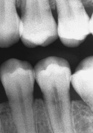 Diente 35: reabsorción cervical como hallazgo casual durante la evaluación diagnóstica de una caries.