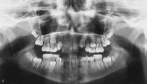 Ortopantomografía de esta paciente de 11 años de edad antes de la extracción del diente 22: erupción ectópica del diente 23 en la región del 22 debido a una anomalía de la forma y del crecimiento radicular inconcluso del diente 22, lo que ha llevado c a un exceso de espacio disponible.