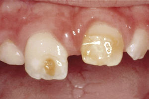 Situación clínica de una paciente de 7 años de edad tras haber sufrido un traumatismo de dientes temporales a la edad de 1 año y medio. Dientes 11 y 21: tinciones del esmalte, muescas y alteraciones en la superficie dentaria acompañadas de anomalías de la forma coronaria. A este tipo de alteración también se le denomina diente de Turner (foto: colección del Prof. Wetzel).