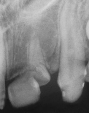 Radiografía de un paciente de 12 años que a los 3 años de edad sufrió un traumatismo de dientes temporales. Diente 11: mineralización incipiente únicamente en la corona, raíz hipotrófica; diente 22: deformación de la corona y de la raíz acompañada de una osteólisis apical del tamaño de una cereza; diente 23: anomalía de la forma de la corona y dilaceración radicular (foto: colección Prof. Wetzel).