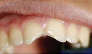 Situación clínica tras un traumatismo de dientes anteriores con fracturas coronarias no omplicadas de los dientes 11 y 21.
