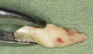 Vista distopalatina del diente 21 no apto para ser conservado con reabsorción radicular visible de origen infeccioso como resultado de un traumatismo con avulsión, reimplantación y un tratamiento endodóntico iniciado.