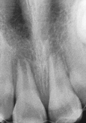 Radiografía obtenida inmediatamente después del traumatismo de los dientes 11 y 21: reposición y fijación con técnica de grabado ácido del esmalte, Tetric Flow y férula de titanio-composite. Diente 11: avulsión y reimplantación; diente 21: luxación extrusiva. Ambos dientes muestran un crecimiento radicular no finalizado.
