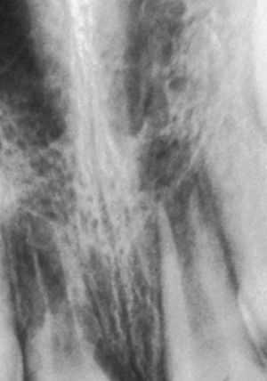 Situación al cabo de 8 semanas: reabsorción radicular incipiente de origen infeccioso en los dientes 11 y 21.