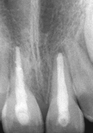 Radiografía obtenida medio año después del traumatismo y del tratamiento endodóntico (gutapercha/ Sealapex) de los dientes 11 y 21. Actualmente: estancamiento de la reabsorción radicular externa.