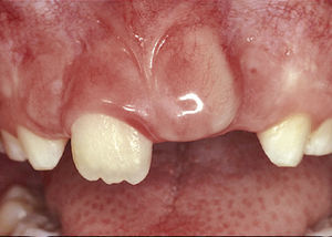 Situación clínica de un niño de 8 años de edad que 3 años antes había sufrido un traumatismo de los dientes 51 y 61. Se vislumbraba perfectamente el diente 21 bajo la mucosa.