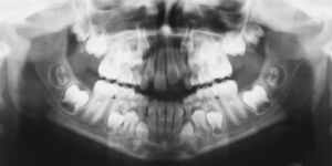 Ortopantomografía del paciente de 8 años: todos los gérmenes dentarios están correctamente posicionados. A diferencia del diente 11, el diente 21 se halla en infraoclusión.