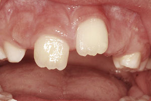 Situación 1 semana después de la exposición quirúrgica del diente 21 que se halla en plena erupción.