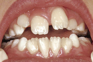 El diente 21 seis meses después de la exposición quirúrgica. Se observa un perfil gingival desfavorable además de la infraoclusión y de la erupción ectópica del diente hacia vestibular.