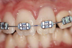 Paciente con aparatología multibandas: el diente 21 está alineado en la arcada. Se logró restablecer un perfil gingival satisfactorio.
