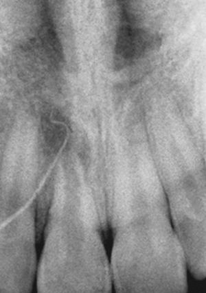 Radiografía de la región del 11: imagen radiolúcida apical del tamaño de un guisante con crecimiento radicular inconcluso del diente 11 y punta de gutapercha en el trayecto fistular.
