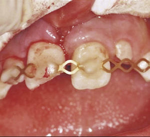 Situación clínica después de la reposición de los dientes 11 y 21, y fijación de la férula TS con composite (técnica de grabado ácido del esmalte, Tetric Flow).