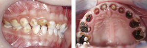 Cuadro clínico de la caries en la primera infancia: entre los signos precoces destacan la placa, la gingivitis, las lesiones iniciales y los defectos por caries posteriores (a) principalmente en los dientes temporales del sector anterosuperior. La administración continua de bebidas azucaradas o con elevado contenido en ácidos con el biberón desencadena este tipo de lesiones que pueden llevar incluso a la destrucción completa de los dientes (b).