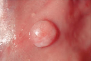 Tumor semiesférico asentado sobre la mucosa bucal.