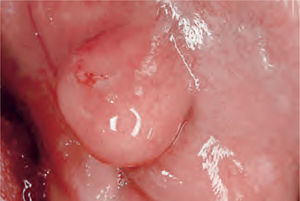 Tumor asentado sobre la mucosa bucal.