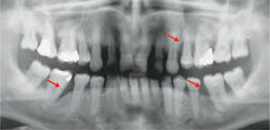 Defectos periodontales (flechas), en los cuales sería recomendable realizar injertos óseos.