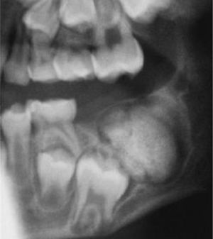 (derecha). Tumor óseo en la región del segundo molar inferior izquierdo; después del injerto óseo el trayecto de erupción del primer molar adyacente atravesará la región injertada.