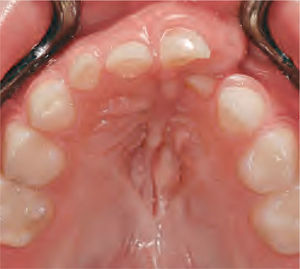 Hendidura alveolar. El movimiento dentario del incisivo lateral izquierdo y la erupción del canino izquierdo van a tener lugar en la zona injertada.