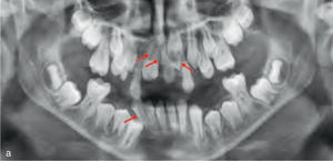 Paciente con displasia cleidocraneal que presenta gérmenes dentarios supernumerarios (flechas).