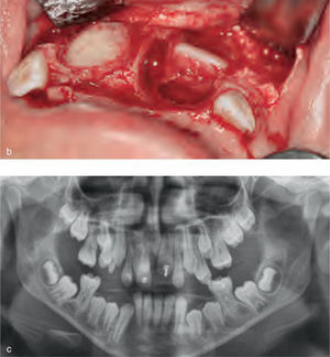 Campo operatorio (b, arriba, derecha). Debido al gran defecto óseo, se realizó un injerto con colágeno, seguido de erupción dentaria soportada (c, abajo, derecha).