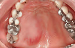 Imagen clínica del nódulo mal delimitado cubierto por una mucosa eritematosa que presentaba una discreta telangiectasia.