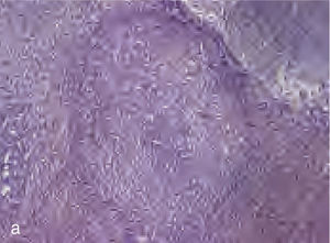 Folículo neoplásico del linfoma folicular (hematoxilina-eosina; 100 X).