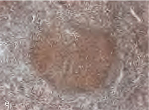 La mayoría de las células neoplásicas eran positivas frente a Bcl2 (100 X).