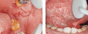 Manifestaciones orales del primer paciente. (a) Erosión exudativa sobre la mucosa yugal con estriaciones blanquecinas periféricas. (b) Patrón reticular liquenoide en la superficie ventral de la lengua.