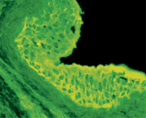 Inmunofluorescencia indirecta con vejiga de rata como substrato que muestra depósitos de IgG, intercelulares y en la membrana basal (40 X originales).