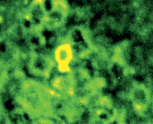 Inmunofluorescencia directa con barrillo citológico como substrato que muestra depósitos de IgG en los espacios intercelulares.