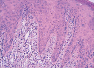Biopsia mucosa de la lengua que reveló degeneración por licuefacción de la capa celular basal, sin que se detectaran ampollas suprabasales (tinción de hematoxilina-eosina; 40 X originales).